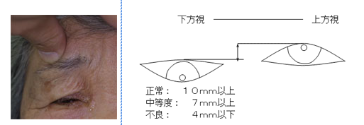 上眼瞼機能の測定